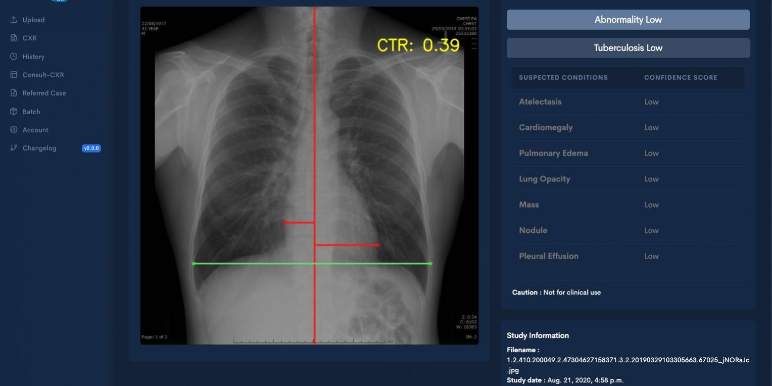 ภาพตัวอย่างผลการอ่านฟิล์มเอกซเรย์โดย ระบบ Inspectra CXR_4